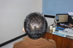 -大麦微针植发丨全国连锁