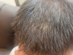 -碧莲盛·不剃发植发