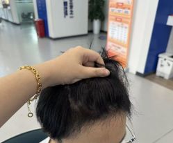 -大麦微针植发全国连锁