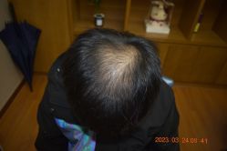 -大麦微针植发全国连锁