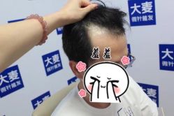 -大麦微针植发丨全国连锁
