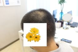 -大麦微针植发丨全国连锁