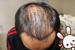 点击看大图 -大麦微针植发丨全国连锁