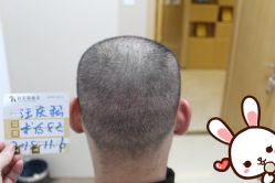 -大麦微针植发丨全国连锁