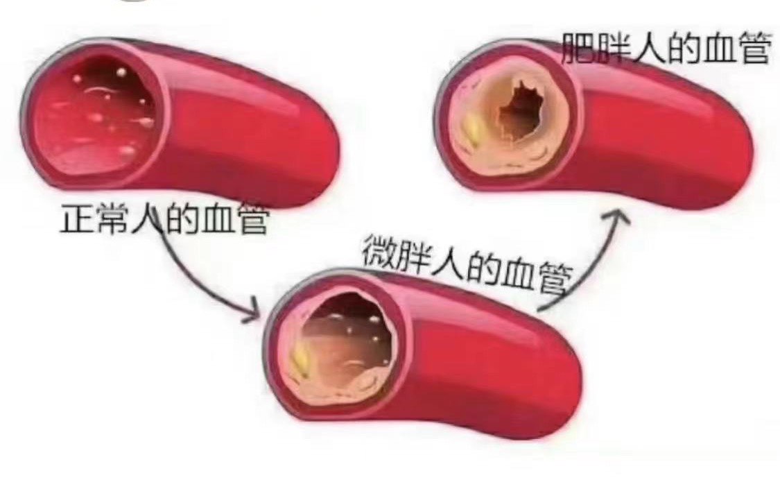 胖人的血管脂肪图片图片