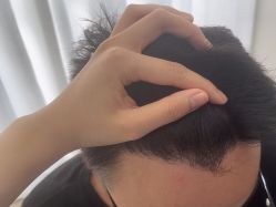 -大麦微针植发丨全国连锁