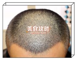 -大麦微针植发全国连锁