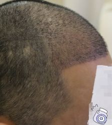 -大麦微针植发丨全国连锁