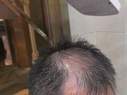 -碧莲盛·不剃发植发