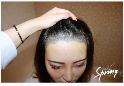 点击看大图 体验后-大麦微针植发全国连锁