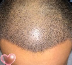 -大麦微针植发丨全国连锁