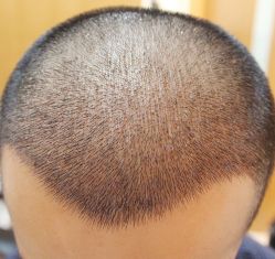 点击看大图 -大麦微针植发丨全国连锁