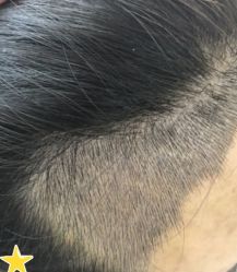 -大麦微针植发丨全国连锁