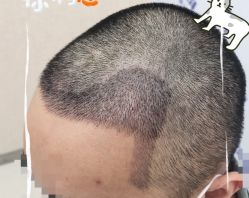 -大麦微针植发全国连锁