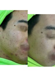 -苗医生0感祛痘连锁