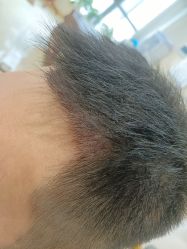 -碧莲盛·不剃发植发