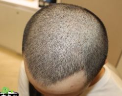 -大麦微针植发丨全国连锁