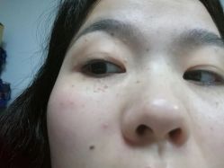 -美丽人生祛斑扁平疣汗管瘤中心