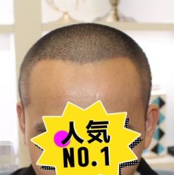 -大麦微针植发丨全国连锁