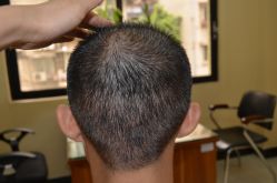 -大麦微针植发丨全国连锁