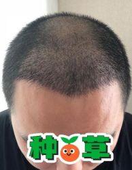 -大麦微针植发丨全国连锁