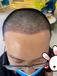-大麦微针植发丨全国连锁