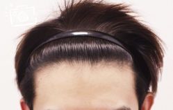 -大麦微针植发丨全国连锁