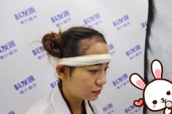 -大麦微针植发丨全国连锁