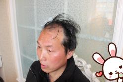 -大麦微针植发丨全国连锁