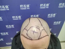 -碧莲盛·不剃发植发