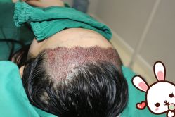 -大麦微针植发丨全国连锁