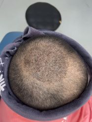 -大麦微针植发全国连锁