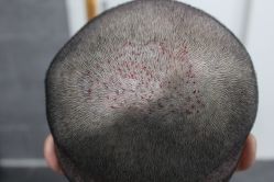 点击看大图 -大麦微针植发丨全国连锁