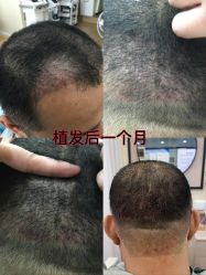 -菩叶脱发白发中心