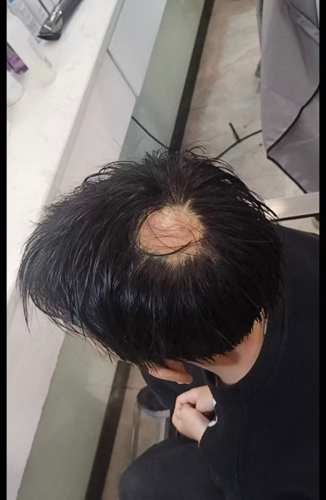 孩子斑秃怎么办?