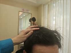 -碧莲盛·不剃发植发