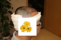 -大麦微针植发丨全国连锁