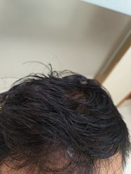 -碧莲盛·不剃发植发