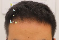 -大麦微针植发全国连锁