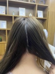 点击看大图 -大麦微针植发全国连锁