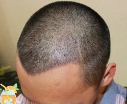 -大麦微针植发丨全国连锁