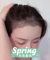 -大麦微针植发全国连锁