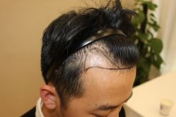 -大麦微针植发丨全国连锁