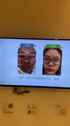 -塑青春&伊肤泉祛痘皮肤管理