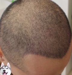 -大麦微针植发丨全国连锁