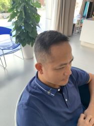 体验后-大麦微针植发全国连锁