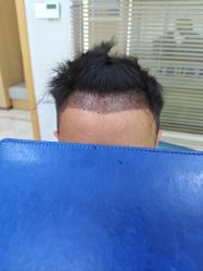 -大麦微针植发丨全国连锁