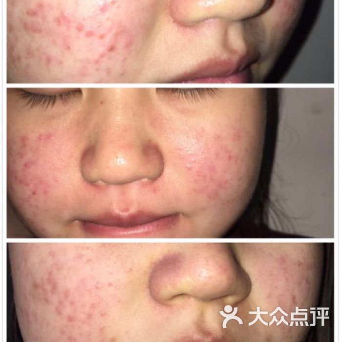 塑青春科技祛痘皮肤管理