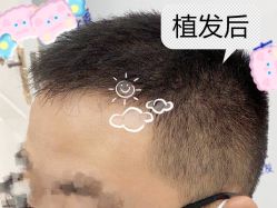 -大麦微针植发全国连锁