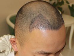 -大麦微针植发全国连锁